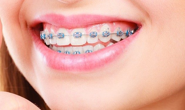 Center-For-Beautiful-Smiles-Braces-Close-Up